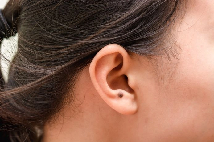 Những nguyên nhân gây mụn ruồi vành tai bạn cần biết