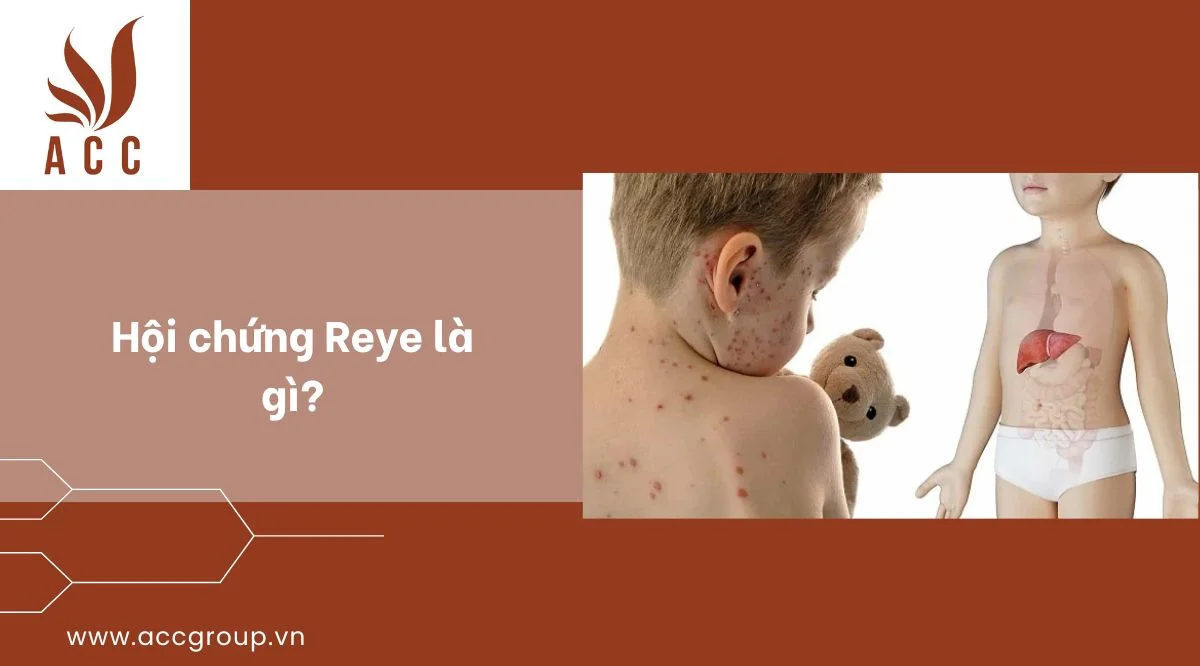 Hội chứng Reye là gì